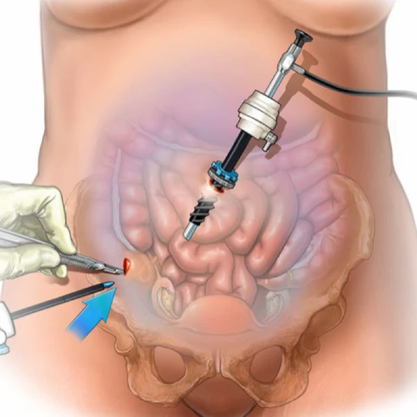 Laparoscopy at Yashoda IVF