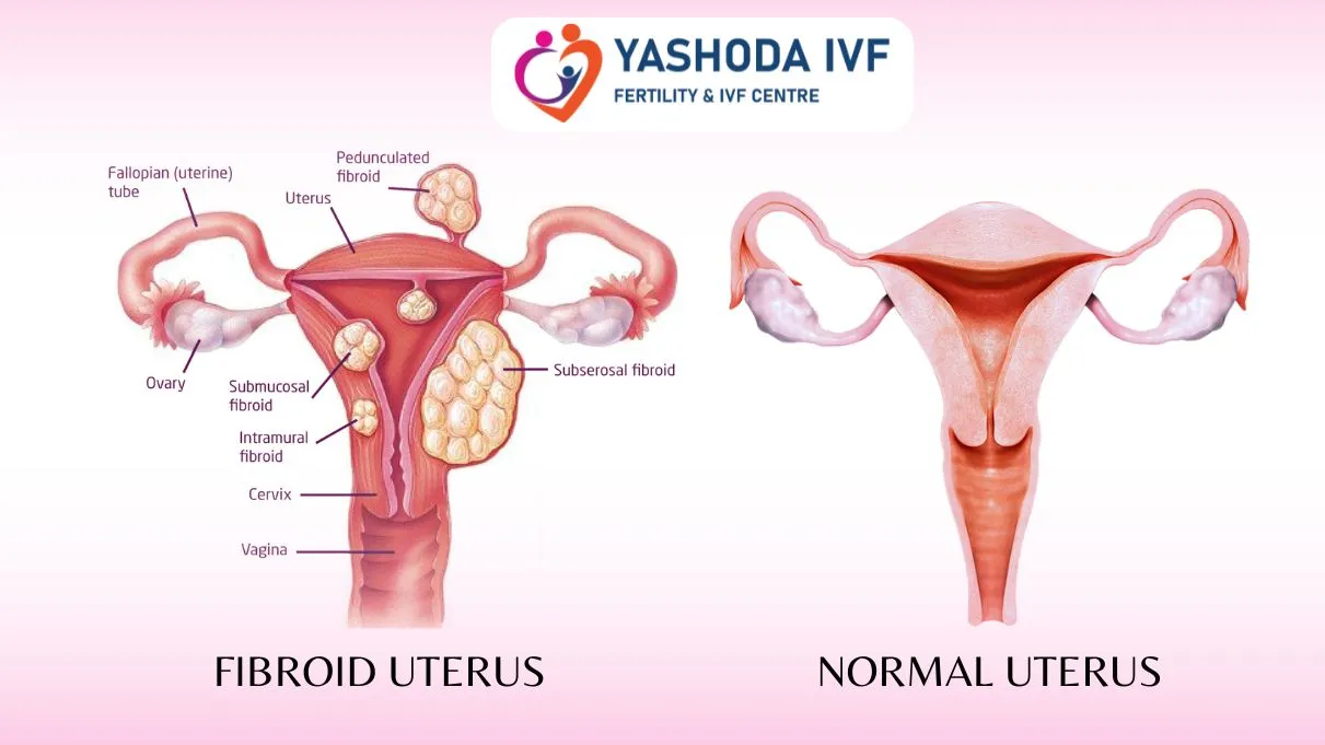 Fibroid uterus and Normal uterus (1)